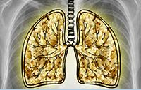 Bronchiolitis obliterans